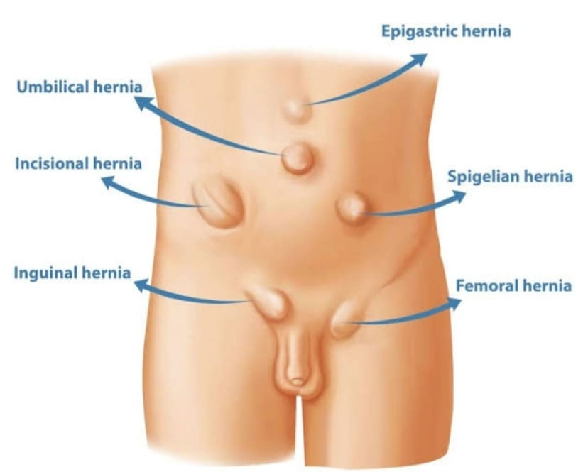 Causes of Hernia